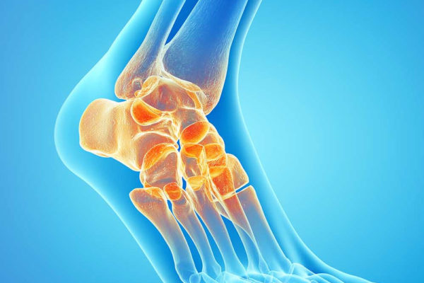 Ankle Osteoarthritis